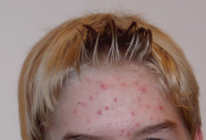 Acne and its Treatment are simpler than you think ... photo by CC user Ellywa on wikimedia commons