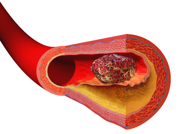 Knowing How to treat and prevent blood clots is vital to protect your life
