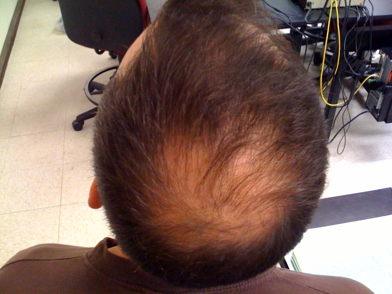 Hair Growth can stem losses like this